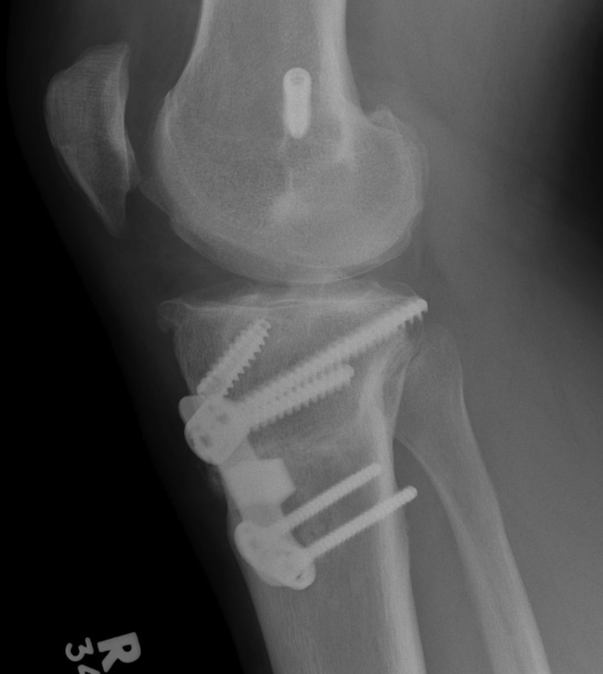 ACL HTO Lateral